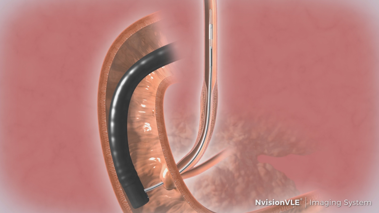 The NvisionVLE Imaging System, now cleared for use in the pancreatico-biliary system, is designed to supply gastroenterologists with more complete information for their biliary examinations by providing subsurface, volumetric, high resolution imaging; seeing what other technologies can’t.