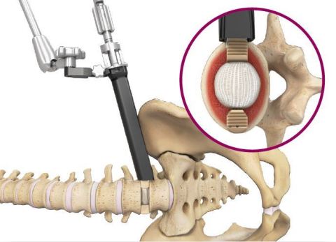 Duo™ Angled Instrumentation System. The angled instrumentation supplements the Duo Lumbar Interbody Fusion System (Graphic: Spineology Inc.)