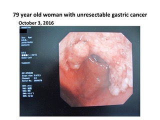 79 year old woman with unresectable gastric cancer: October 3, 2016 (Photo: Business Wire)