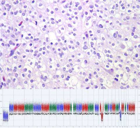 Oligodendroglioma 
Photo Courtesy Daniel J. Brat, MD, PhD, FCAP