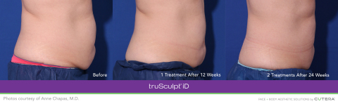 Before and After with truSculpt® iD Body Sculpting Technology (Photo: Business Wire)