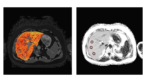 LiverMultiScan images of a liver with high cT1 values and high PDFF (Photo: Business Wire)