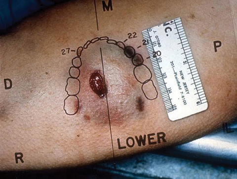 Human Bite Injury (Photo: Business Wire)