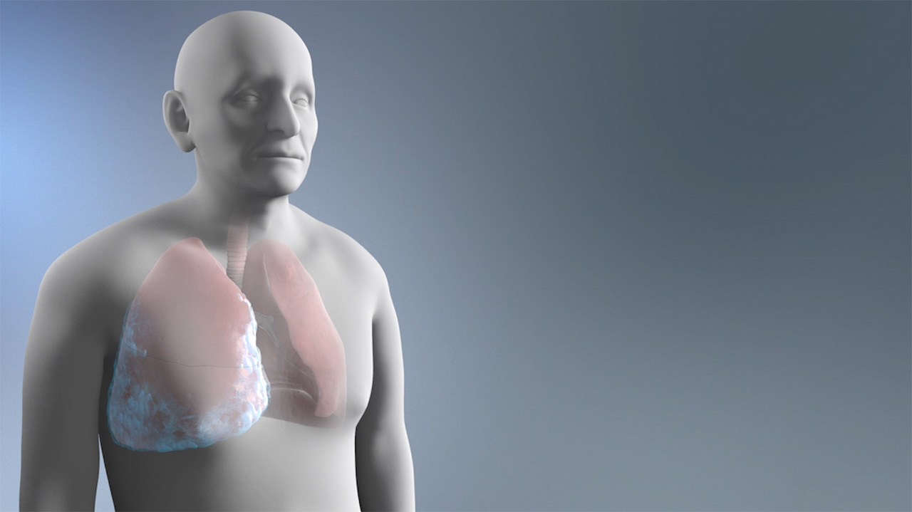 mesothelioma lung cancer lawsuit