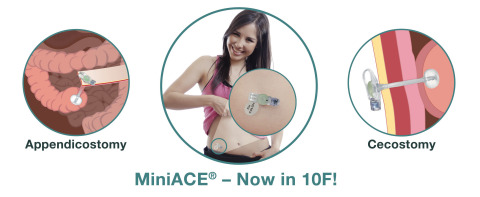 The newly expanded line of MiniACE Low Profile Enema Buttons serves more patients with Antegrade Continence Enema procedures. (Graphic: Business Wire)