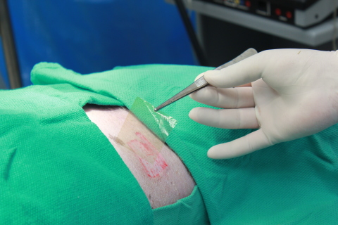 Microlyte Matrix is an ultrathin bandage made with bioresorbable polymers and a patented antimicrobial silver nanotechnology, shown here over a surgical wound (Photo: Business Wire)