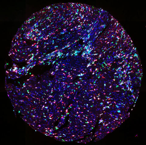 TMA of colorectal cancer stained with UltiMapper I/O MDSC kit (CD11b green, CD14 red, CD15 magenta, HLA-DR cyan) (Photo: Business Wire)