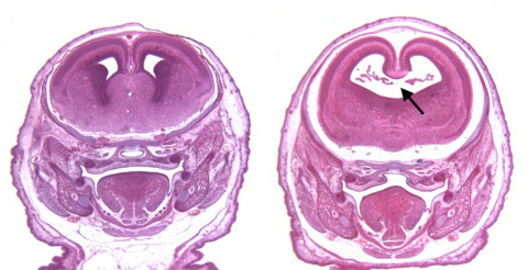 Cannabinoids exacerbate alcohol-induced brain defects. Images are stained sections of fetal mouse brains. (Left) The brain of a control mouse. (Right) The brain of a mouse exposed to alcohol and a cannabinoid on the 8th day of pregnancy. Note the enlarged cerebral ventricle caused by the loss of the midline septal region (black arrow). (Photo: Business Wire)