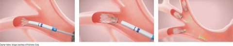 El nuevo informe de 2020 de la Global Initiative for Chronic Obstructive Lung Disease (GOLD) otorga la máxima calificación de evidencia a las válvulas endobronquiales, incluida la válvula Zephyr, para el tratamiento del enfisema / EPOC