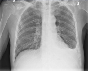 Pleural Effusion for demonstration use only. (Photo: Business Wire)