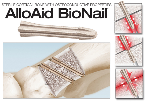 The innovative AlloAid BioNail™ allograft implant gives surgeons an option to traditional metallic implants for hand and foot surgery, providing several benefits both pre- and post-operatively. The BioNail is the sixth allograft product offered by In2Bones Global, the market leader in engineered, sterile allografts. (Graphic: Business Wire)