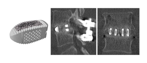 Mimetic Metal's streamlined titanium alloy (Ti-6AL-4V ELI) support structure minimizes overall implant density, resulting in beneficial imaging characteristics. (Photo: Business Wire)