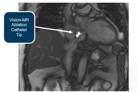 thumbnail Active Catheter Imaging of the Vision-MR Ablation Catheter (Photo: Heart Center Dresden).