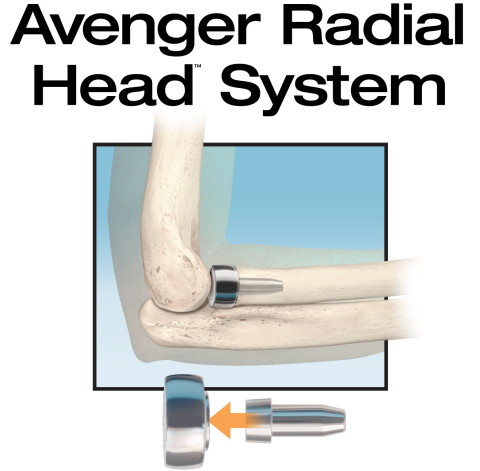 The new Avenger Radial Head System from In2Bones Global is the first to include sterile, single-use instruments. Design features enable easier insertion for trauma cases, improved implant and elbow stability, and positive long-term clinical outcomes. (Graphic: Business Wire)