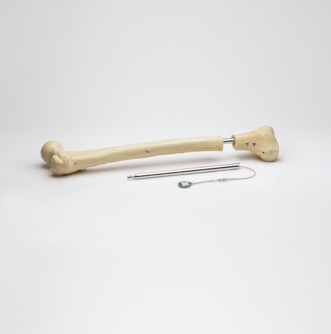 FITBONE intramedullary lengthening system for lengthening of the femur and tibia bones. (Photo: Business Wire)