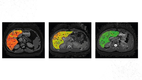 Sample cT1 images from LiverMultiScan® (Photo: Business Wire)