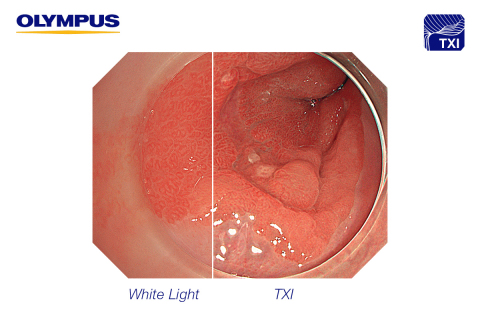 EVIS X1 white light vs. TXI (Photo: Business Wire)