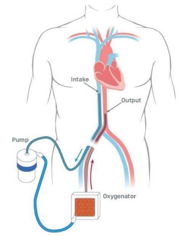 A diagram of a percutaneous ECMO system. Source: Cooper Health Care System, South Jersey Medical Report