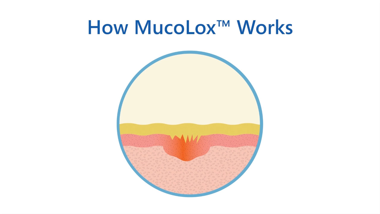 MucoLox™ adheres to mucous membranes as it delivers active ingredients, increasing contact time between medication and the affected tissue.