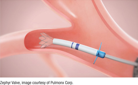 The Zephyr Valve for Emphysema / COPD (Photo: Business Wire)