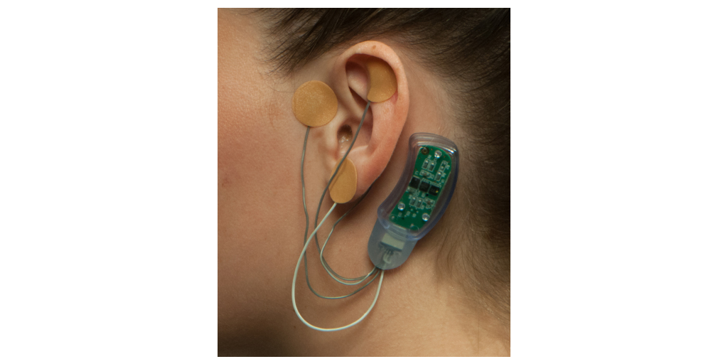 A percutaneous auricular nerve stimulation system (NSS-2 Bridge