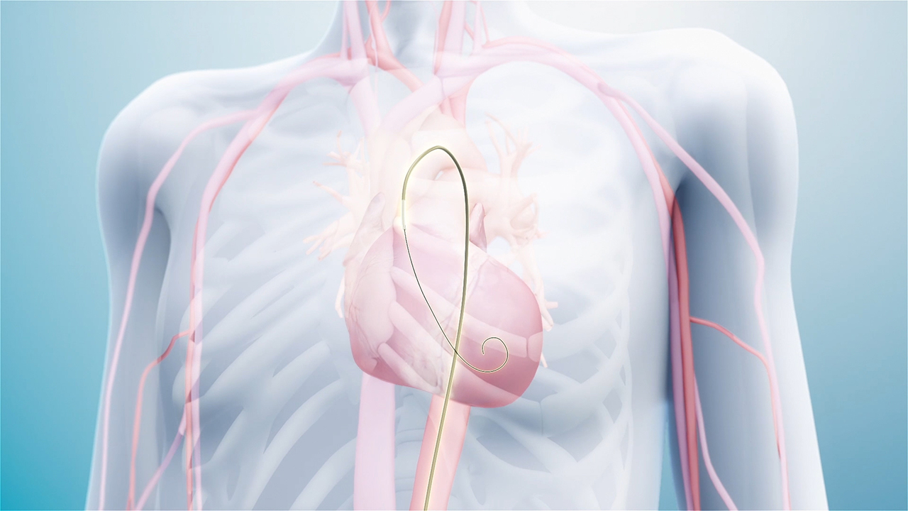 The AccuCinch® Ventricular Restoration System is the first completely percutaneous device designed to directly reshape the left ventricle of the heart, thereby addressing the fundamental issue in the progression of systolic heart failure.