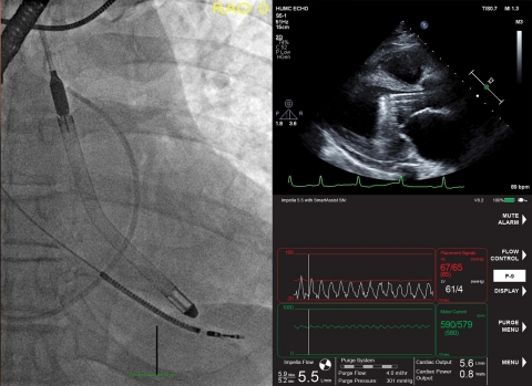 The Impella 5.5 with SmartAssist is featured on the front cover of the July 2020 edition of the ASAIO Journal. (Photo: Business Wire)