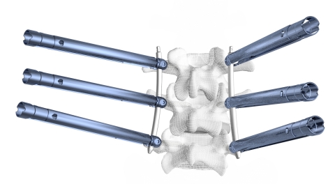 The Tiger MIS X-Tab System features polyaxial, extended tab pedicle screws. (Photo: Business Wire)