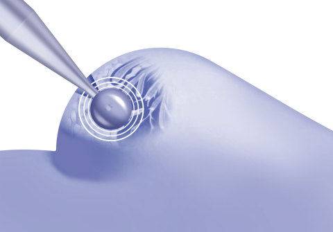 With intraoperative radiation therapy (IORT), using ZEISS INTRABEAM, the tumor bed is irradiated directly after tumor resection, intraoperatively. (Graphic: Zeiss)