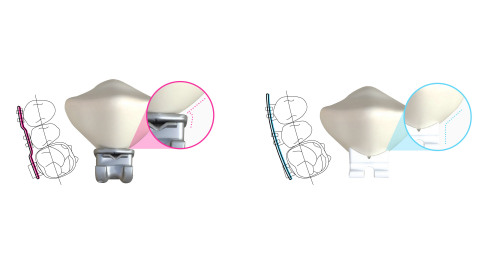 LightForce enables orthodontists to utilize its 3D-printing technology to create custom braces for each individual patient, significantly reducing the number of adjustment visits needed. (Photo: Business Wire)