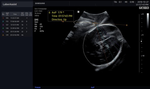 Samsung Medison's LaborAssist ultrasound image shows a fetus’ angle of progression. Samsung Medison and Intel are collaborating on new smart workflow solutions to improve obstetric measurements that contribute to maternal and fetal safety and can help save lives. (Credit: Samsung Medison)