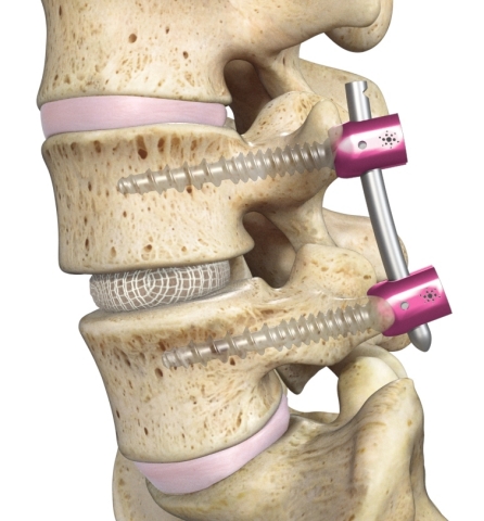 OptiLIF™, featuring the Spineology OptiMesh® Expandable Interbody Fusion System (Photo: Business Wire)