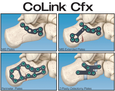 The CoLink® Cfx Calcaneal Fixation System is a versatile collection of low-profile plates designed to address all types of traumatic fractures and osteotomies of the calcaneus (heel bone). (Graphic: Business Wire)