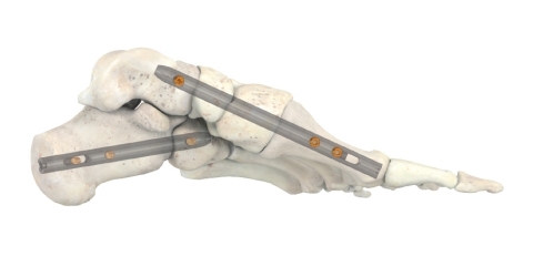 Stryker's new T2® ICF Intramedullary nailing system offers solution for patients suffering from serious foot conditions such as Charcot foot—a condition associated with diabetes. (Graphic: Business Wire)