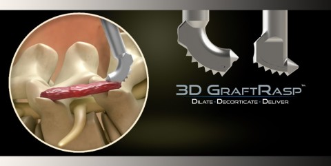 3D GraftRasp System (Photo: Business Wire)