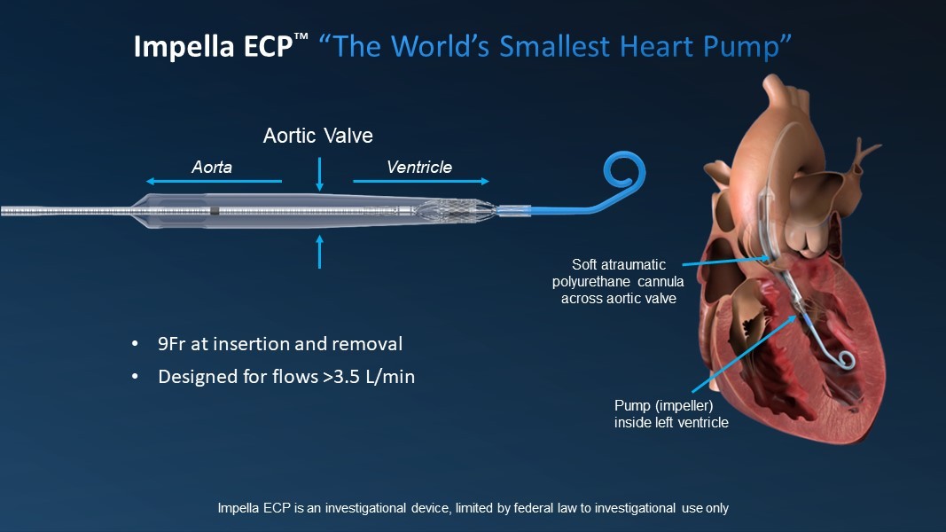 世界最小心臓ポンプの9fr Impella Ecpで初めて患者を治療 Business Wire