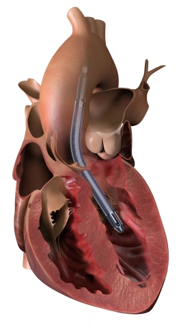 SmartAssist搭載Impella5.5は、左心室の血液をポンプ先端近くの吸入部からくみ出して、カテーテルを通じて上行大動脈に送り出す。 （画像：ビジネスワイヤ）