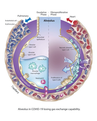 Alveolus in COVID-19 losing gas exchange capability (Graphic: Business Wire)