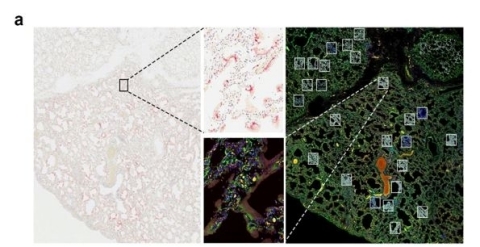 Figure A: SARS Co-V2 is visualized in infected lung tissue from 6 different tissue samples with ACD RNAscope probe (pink), and corresponding virus-positive and virus-negative ROIs were selected from a serial section for GeoMx profiling with the Cancer Transcriptome Atlas. (Graphic: Business Wire)