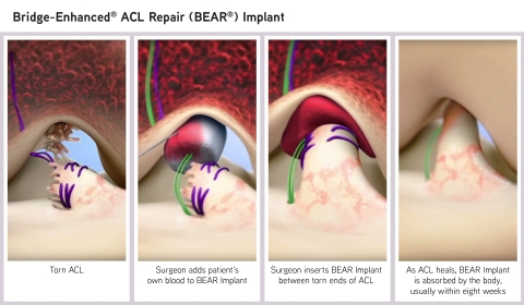 The Bridge-Enhanced® ACL Repair (BEAR®) Implant is the first medical technology to clinically demonstrate that it enables healing – or restoration – of the patient’s torn ACL. The surgeon injects a small amount of the patient’s own blood into the implant and inserts it between the torn ends of the ACL in a minimally invasive procedure. The combination of the BEAR Implant and the patient’s blood enables the body to heal the torn ends of the ACL back together while maintaining the ACL’s original attachments to the femur and tibia. As the ACL heals, the BEAR Implant is absorbed by the body, within approximately eight weeks. This new approach is a paradigm shift from the current standard of care – reconstruction that replaces the ACL with a graft – and is the first new treatment for ACL tears in more than 30 years. (Graphic: Business Wire)