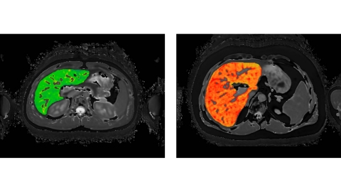 LiverMultiScan example image of low cT1 and high cT1. (Photo: Business Wire)