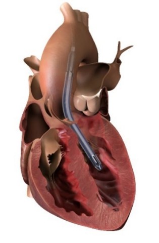 Impella 5.5 with SmartAssist pulls blood from the left ventricle through an inlet area near the tip of the pump and expels blood through the catheter into the ascending aorta. (Graphic: Business Wire)