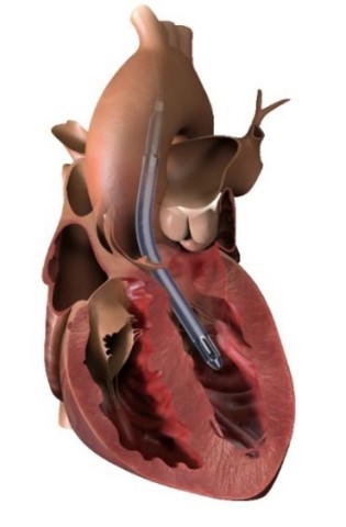 thumbnail Impella 5.5 with SmartAssist pulls blood from the left ventricle through an inlet area near the tip of the pump and expels blood through the catheter into the ascending aorta. (Graphic: Business Wire)