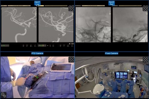 MedPresence® proctor view during an intracranial vascular implant case. By using MedPresence, a proctor in Canada with extensive experience placing the implant was able to supervise the procedure taking place at Lahey Hospital & Medical Center in Burlington, MA. The views were configured remotely and included a live digitally subtracted roadmap (top left) and unsubtracted (top right) images in various planes. A pan-tilt-zoom camera (bottom left) provides a view of the operator's hands and equipment and demonstrates the radial access. A fixed camera mounted to the ceiling provides an overview of activity in the room (bottom right). (Figure reproduced from Journal of NeuroInterventional Surgery, International teleproctoring in neurointerventional surgery and its potential impact on clinical trials in the era of COVID-19: legal and technical considerations, Emanuele Orru', Miklos Marosfoi, Neil V Patel, Alexander L Coon, Christoph Wald, Nicholas Repucci, Patrick Nicholson, Vitor M Pereira, Ajay K Wakhloo, Published Online First: 21 December 2020, Copyright notice 2021 with permission from BMJ Publishing Group Ltd.)
