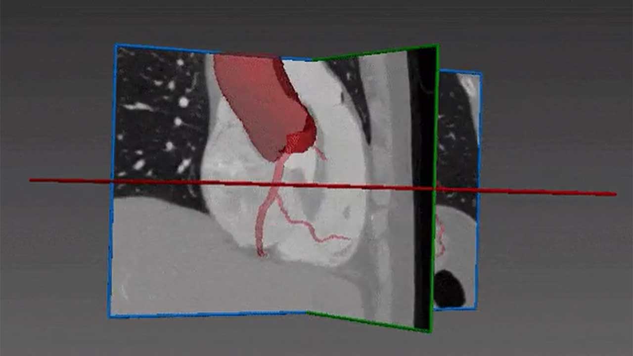 Coronary Computed Tomography Angiography (CCTA) with deep learning.