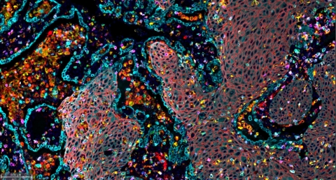非小細胞肺がん（NSCLC）試料における免疫浸潤を示すマルチプレックス免疫蛍光画像。（写真：ビジネスワイヤ）