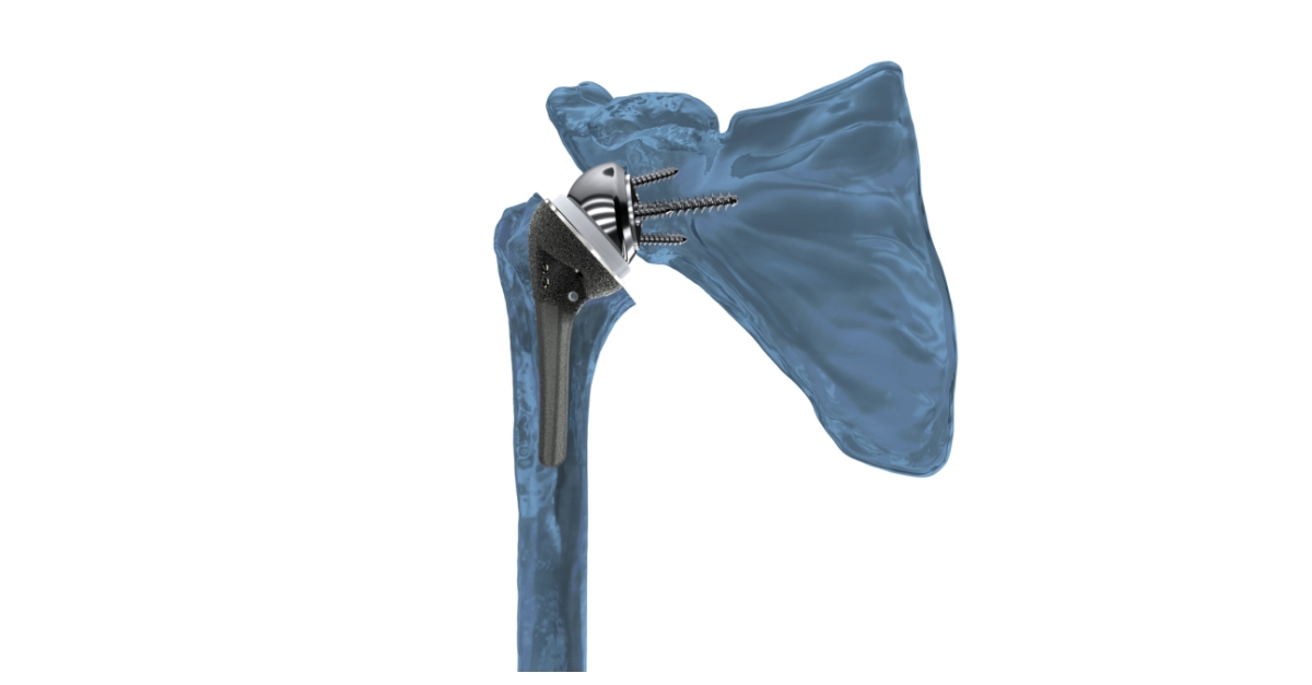 Catalyst OrthoScience Announces First Surgeries Using Archer™ R1 ...