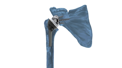 Catalyst OrthoScience's Archer™ R1 Reverse Shoulder System offers surgeon-targeted implant positioning, a streamlined and versatile system, and bone sparing implants. The single-tray arthroplasty system was engineered to combine the most beneficial and evidence-based attributes of reverse shoulder arthroplasty design. (Photo: Business Wire)