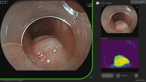 original Provided by Professor Pradeep Bhandari: “Once the neoplasia is found, the system takes a still image and transfers it to the top right corner of a screen as a reference image for endoscopists. It also has a heat map which shows the area of the AI-predicted neoplasia.” (Graphic: Business Wire)