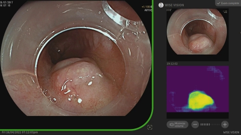 Provided by Professor Pradeep Bhandari: “Once the neoplasia is found, the system takes a still image and transfers it to the top right corner of a screen as a reference image for endoscopists. It also has a heat map which shows the area of the AI-predicted neoplasia.” (Graphic: Business Wire)